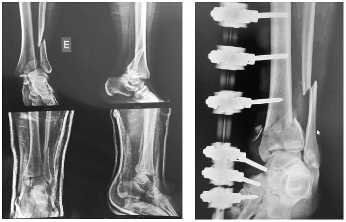 cirurgia-tornozelo-dr-ivan-giarola-ortopedista-tornozelo-sao-paulo