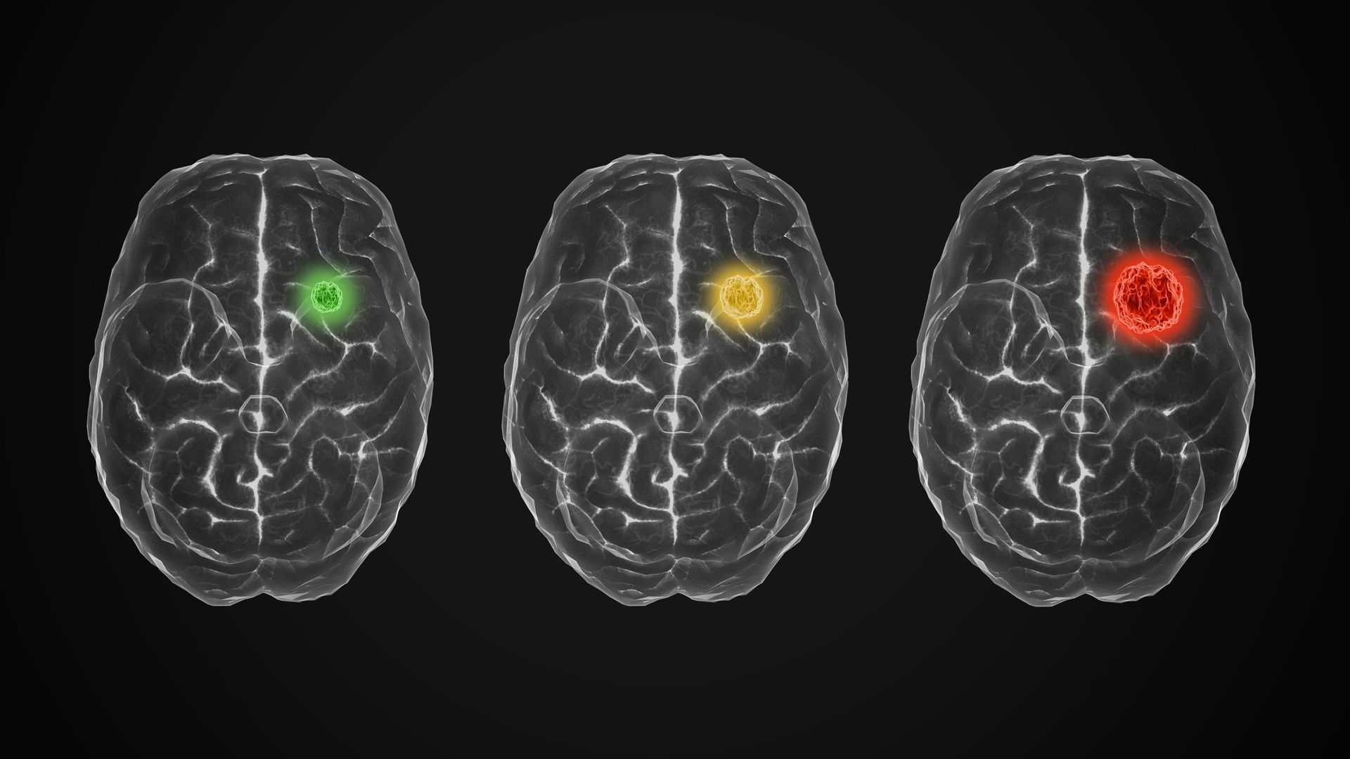 Three transparent brain scans showing progressive activation from green to yellow to red, illustrating how trauma intensifies neural activity and strengthens thinking traps in the brain.