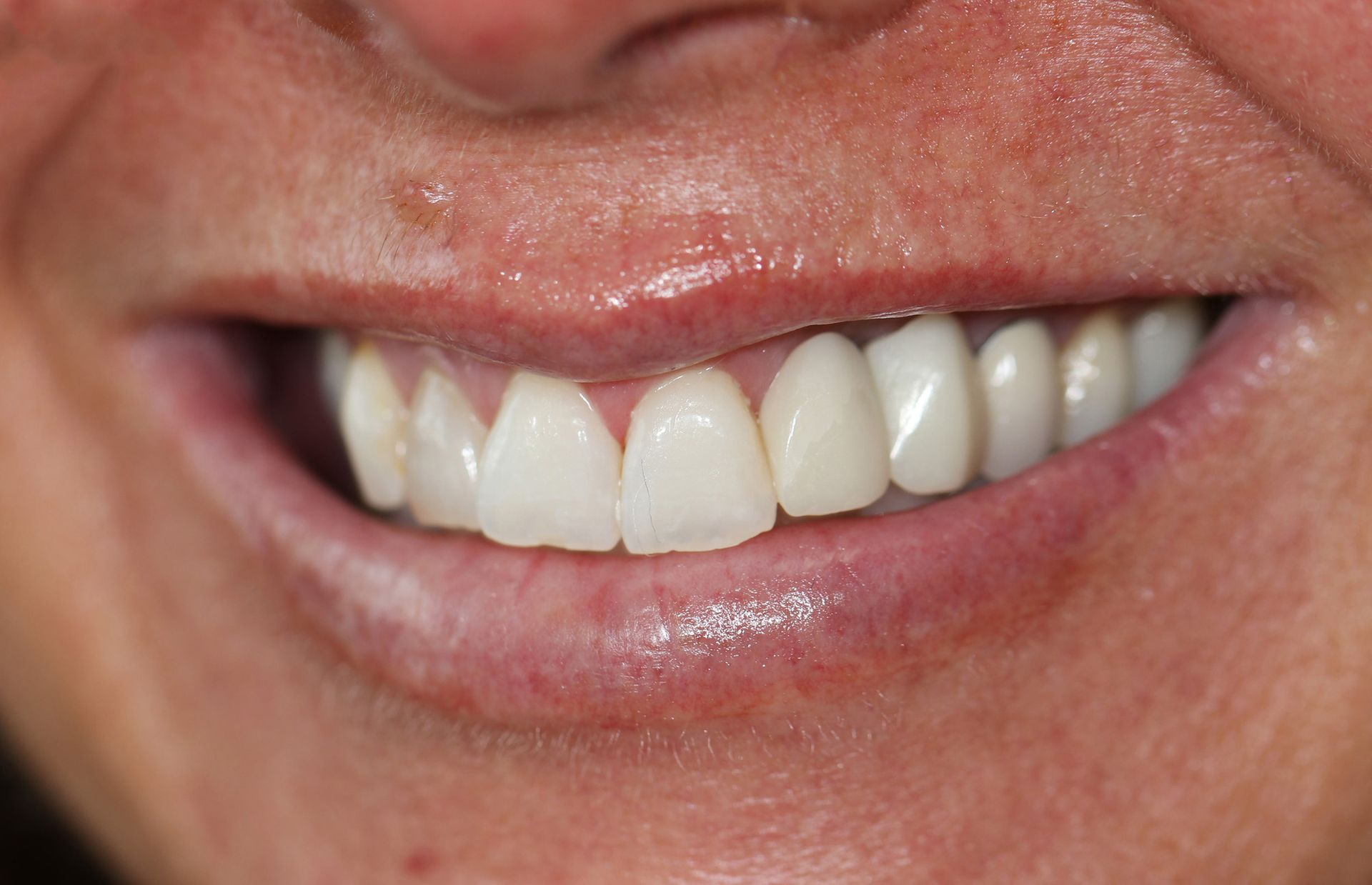 A close up of a woman 's smile with white teeth.
