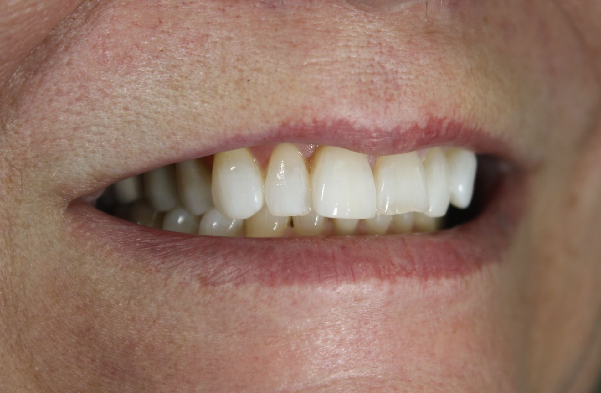 A close up of a woman 's mouth with white teeth.