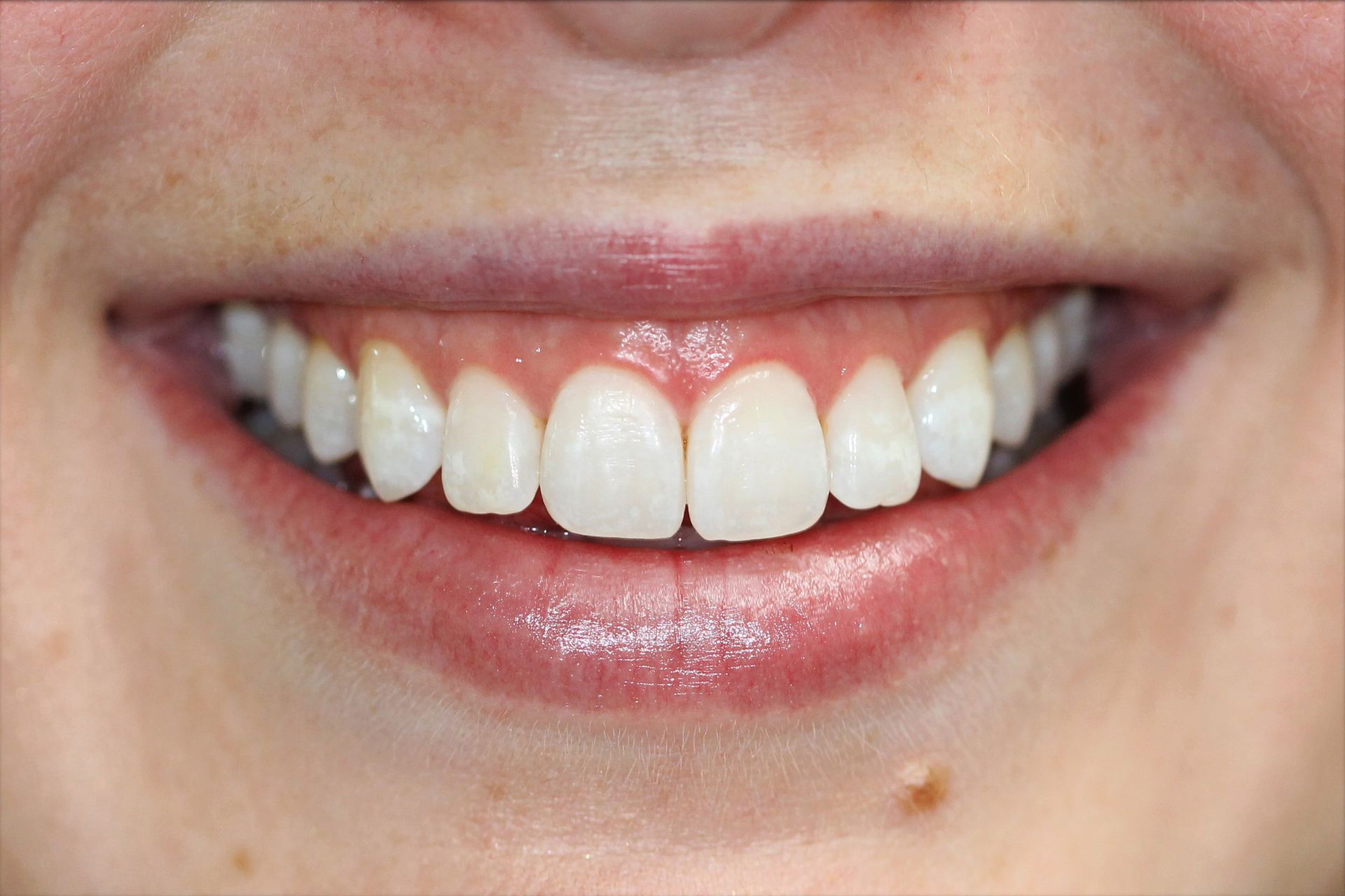 A close up of a woman 's smile with white teeth.