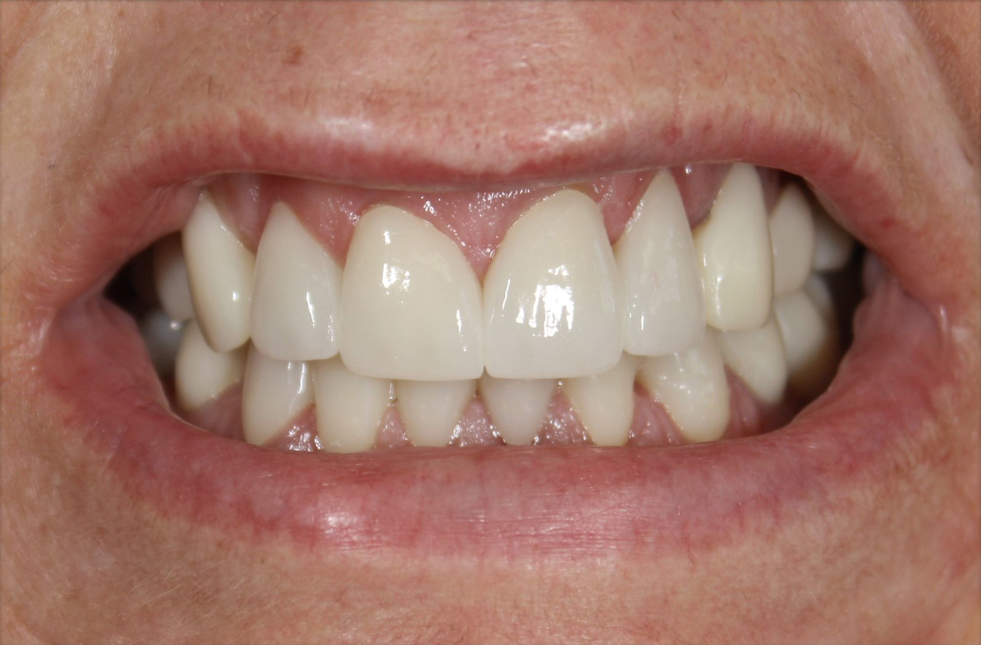A close up of a person 's mouth with white teeth