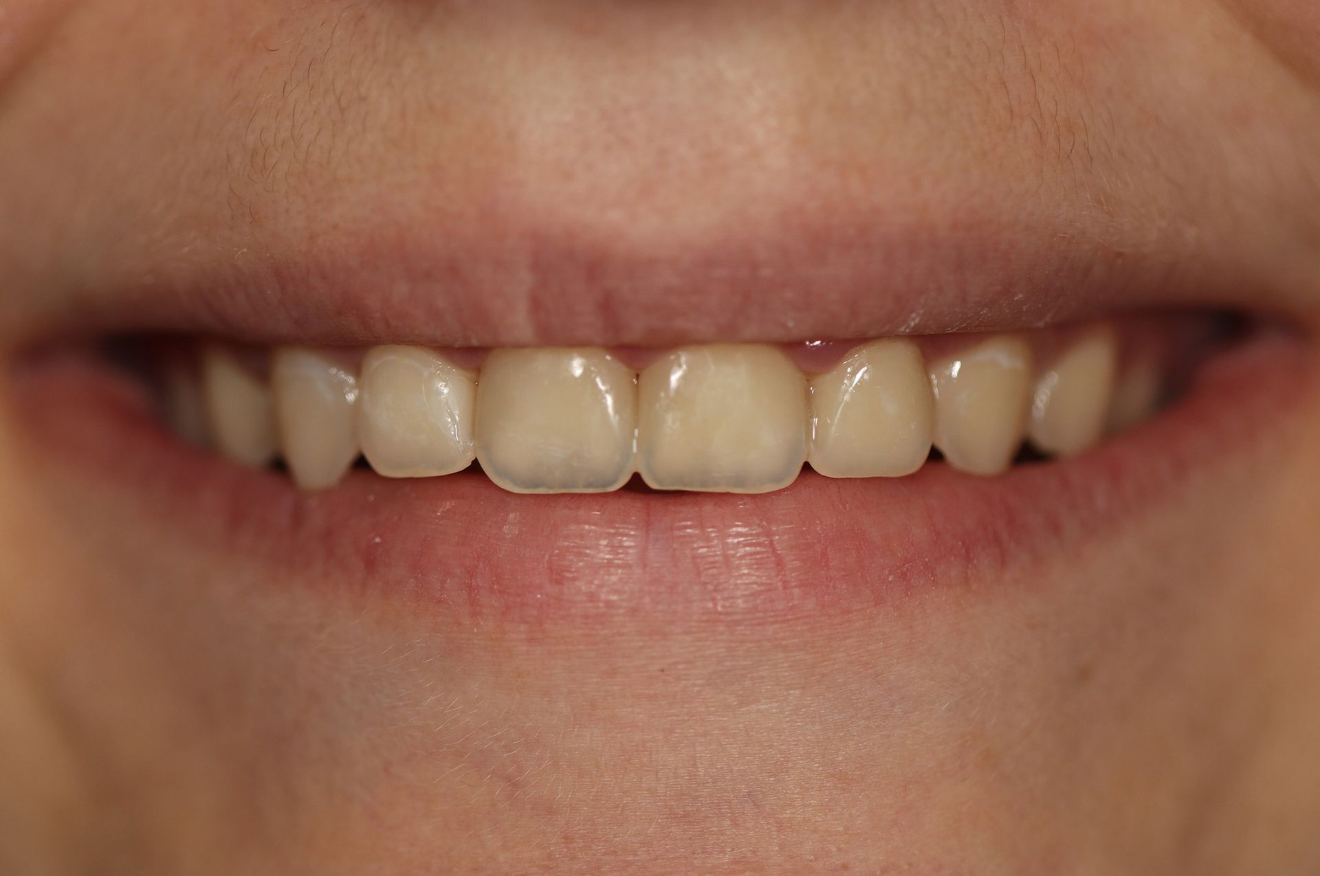 A close up of a person 's mouth with white teeth.