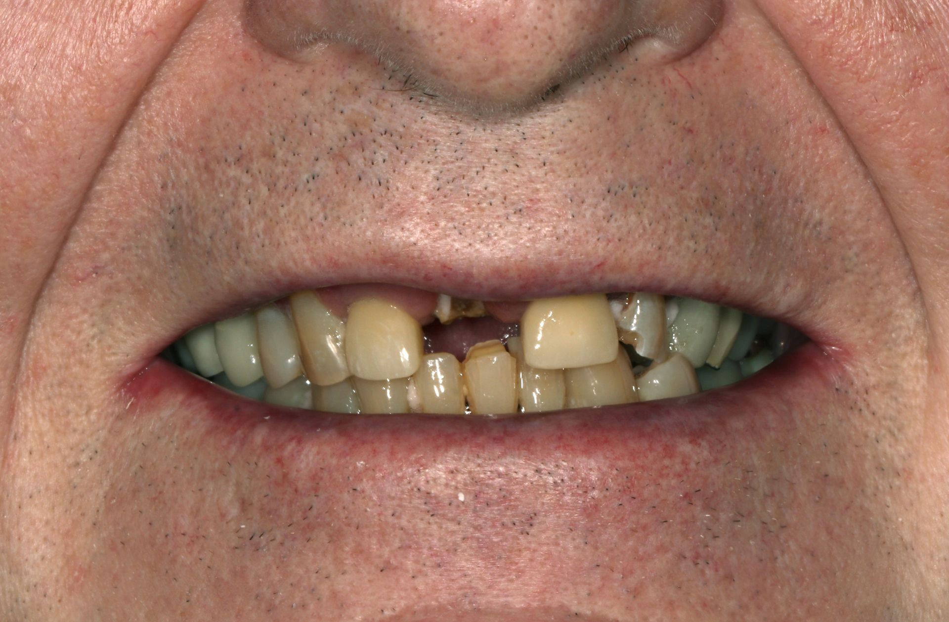 A close up of a man 's mouth with missing teeth.