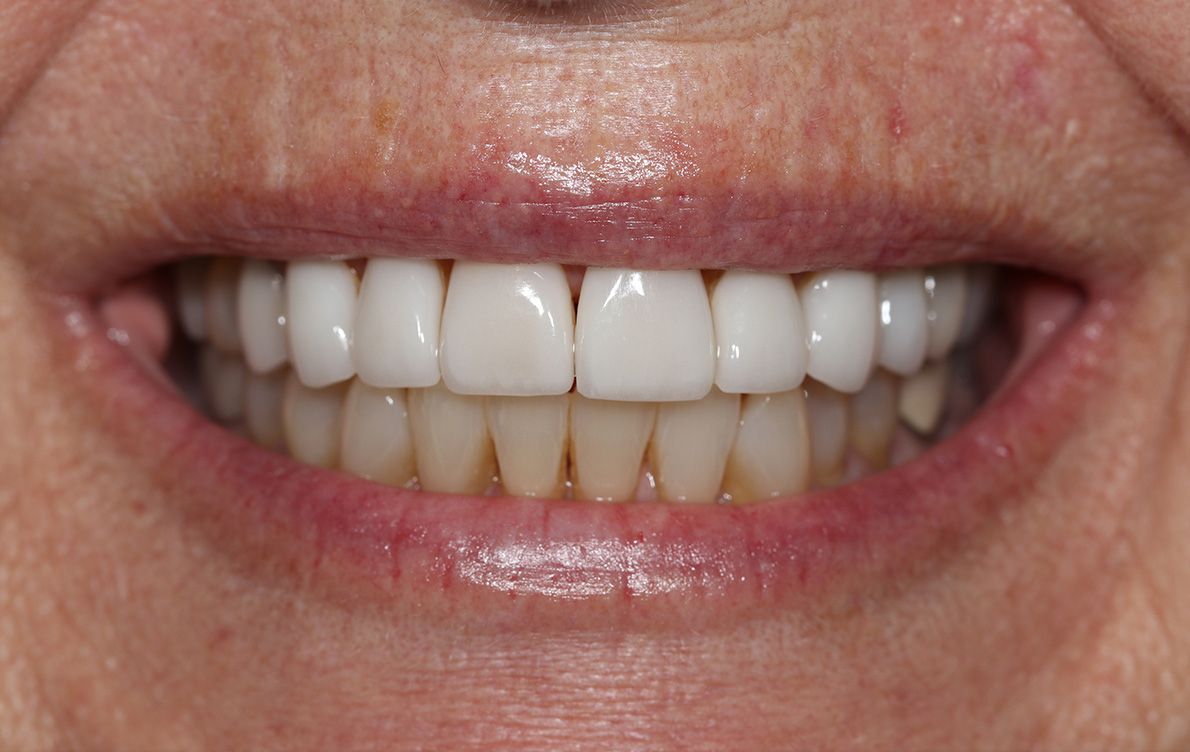 A close up of a woman 's smile with white teeth.