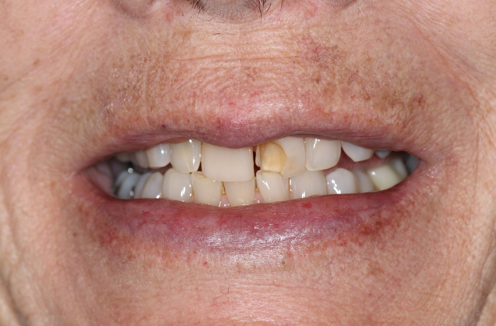 A close up of a person 's mouth with a broken tooth.