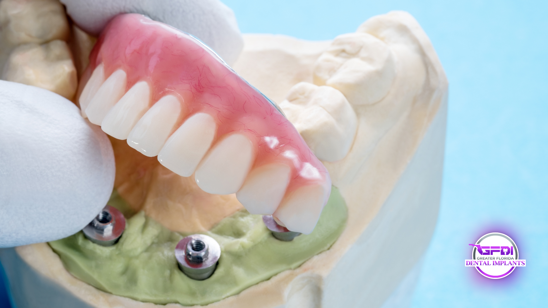 A hand in a white glove holding a dental prosthesis over a model with implants.