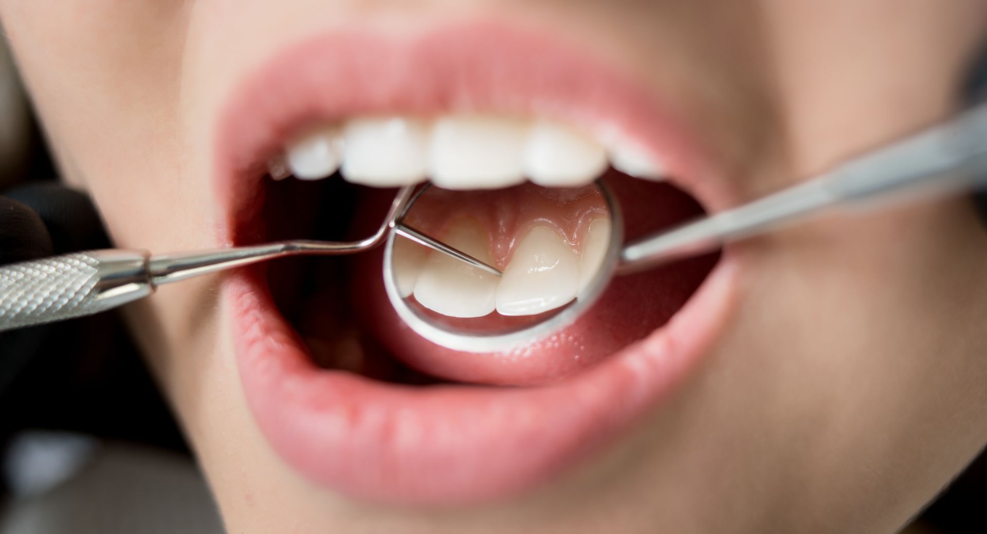 Dental tools examining open mouth with visible teeth and tongue