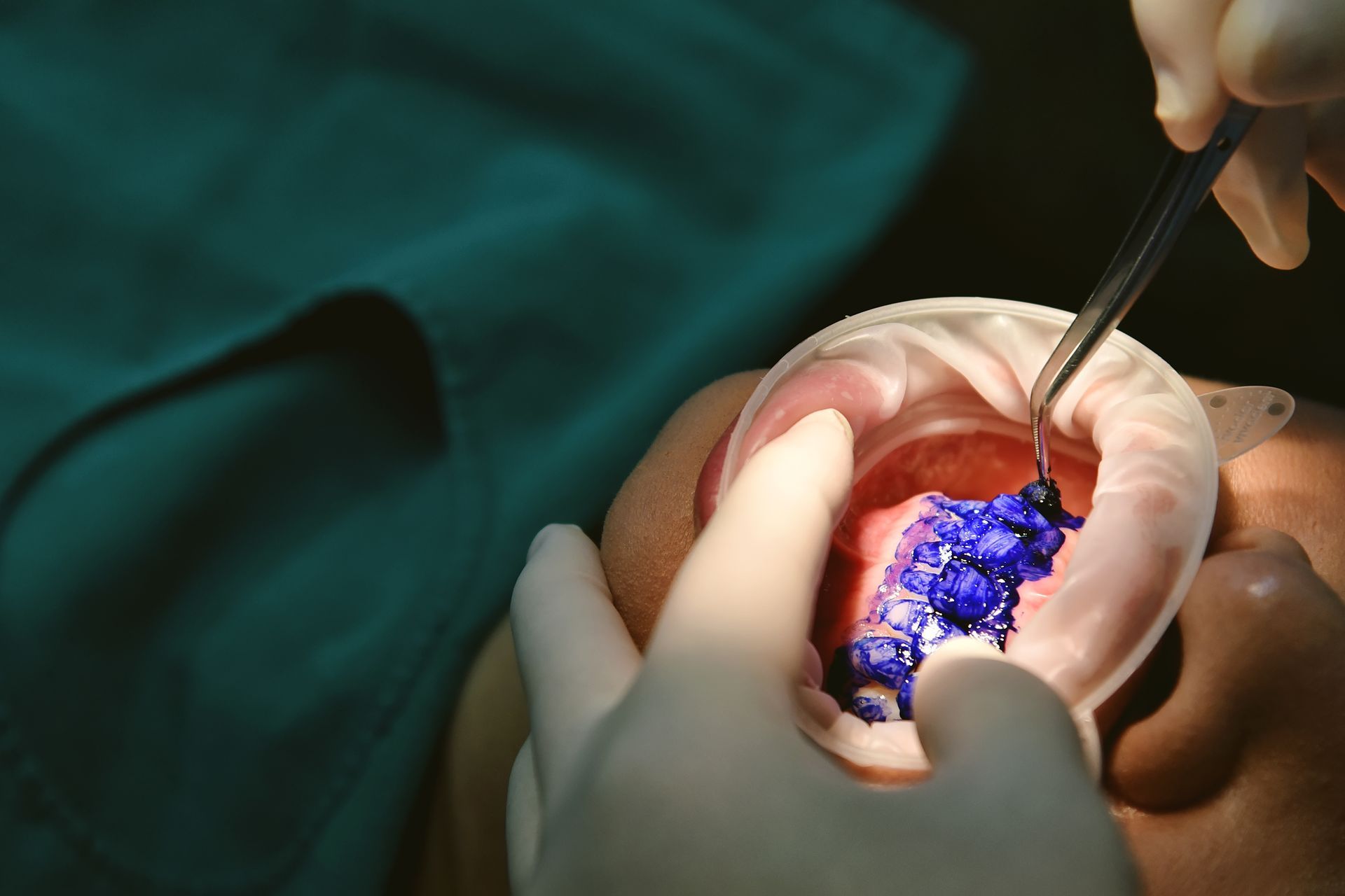 Dentist performing a dental procedure on an open mouth with bright blue filling material.