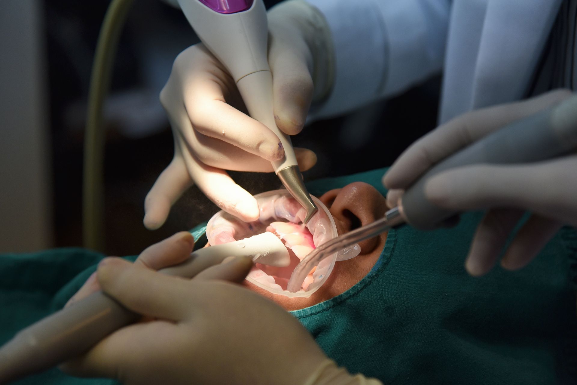 Dentists performing a tooth extraction with surgical tools under bright light