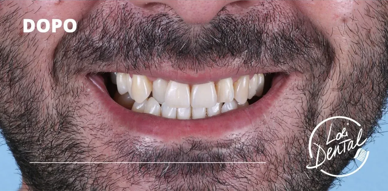 Primo piano della bocca sorridente di una persona che mostra denti bianchi e allineati, con la scritta