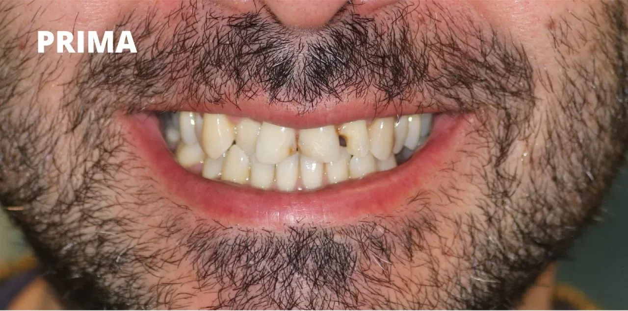 Primo piano della bocca di una persona che mostra denti disallineati, 