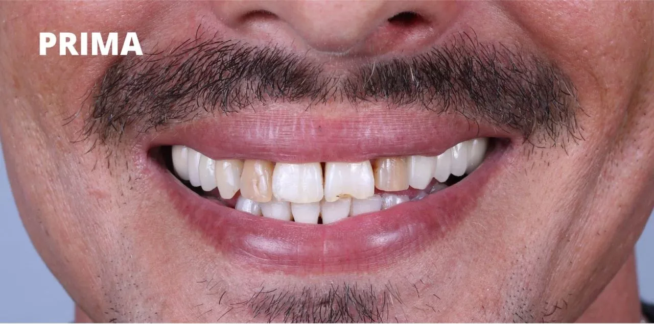 Un primo piano della bocca di una persona che mostra denti scoloriti e con bordi irregolari, etichettati 