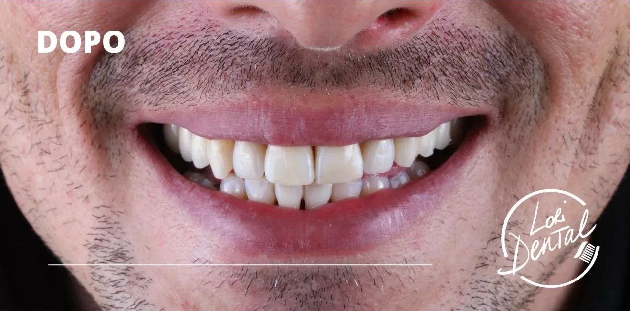 Primo piano di una bocca sorridente con denti bianchi e allineati