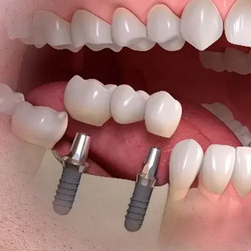 Illustrazione 3D che mostra un ponte dentale implantare posizionato su due impianti metallici in una mandibola umana.