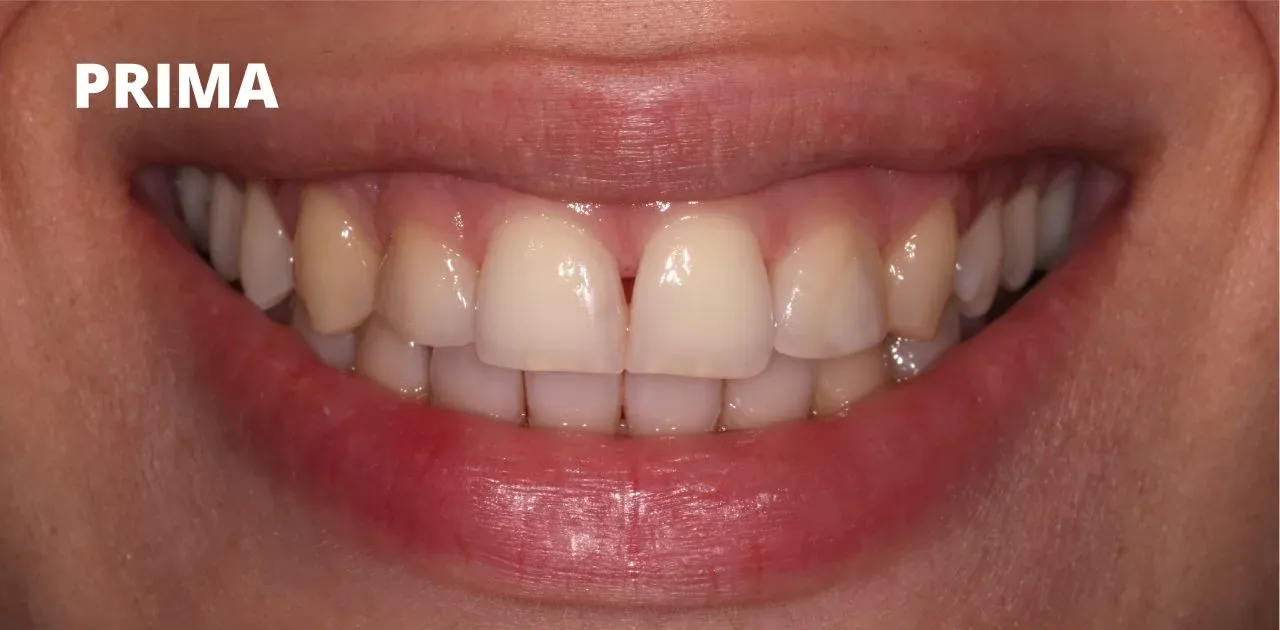 Primo piano di una bocca sorridente che mostra denti naturali con un piccolo spazio tra i due incisivi centrali anteriori.
