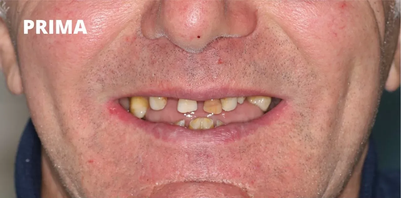 Primo piano della bocca di una persona che mostra denti mancanti, scoloriti e consumati,