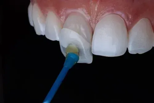 Implantologia dentale - Procedura di impianto