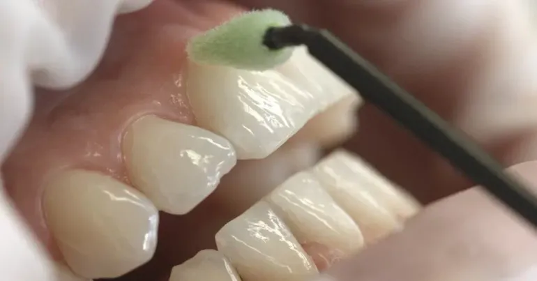 Implantologia dentale - Procedura di impianto