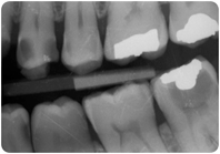 Radiografia interprossimale che mostra i denti posteriori superiori e inferiori con diverse otturazioni metalliche.