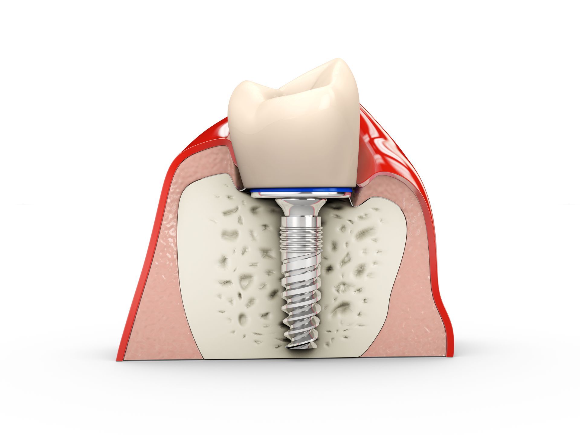 an illustration of a tooth with a screw in it