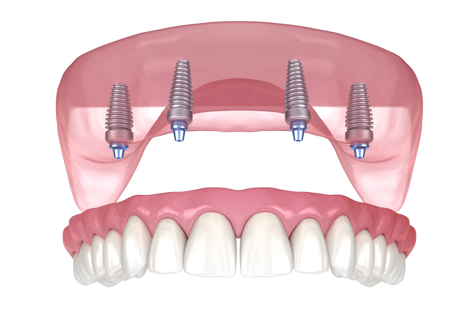 an illustration of a denture with four dental implants