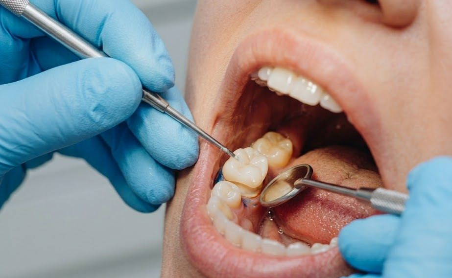 Dentist using tools to examine a patient’s teeth during a dental procedure.
