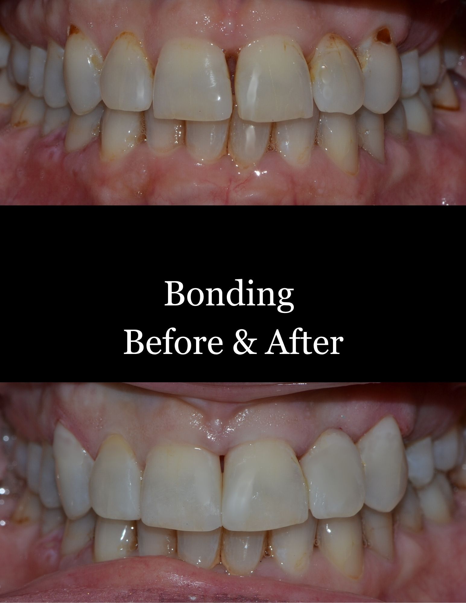 Dental bonding before-and-after comparison of upper and lower teeth with centered text