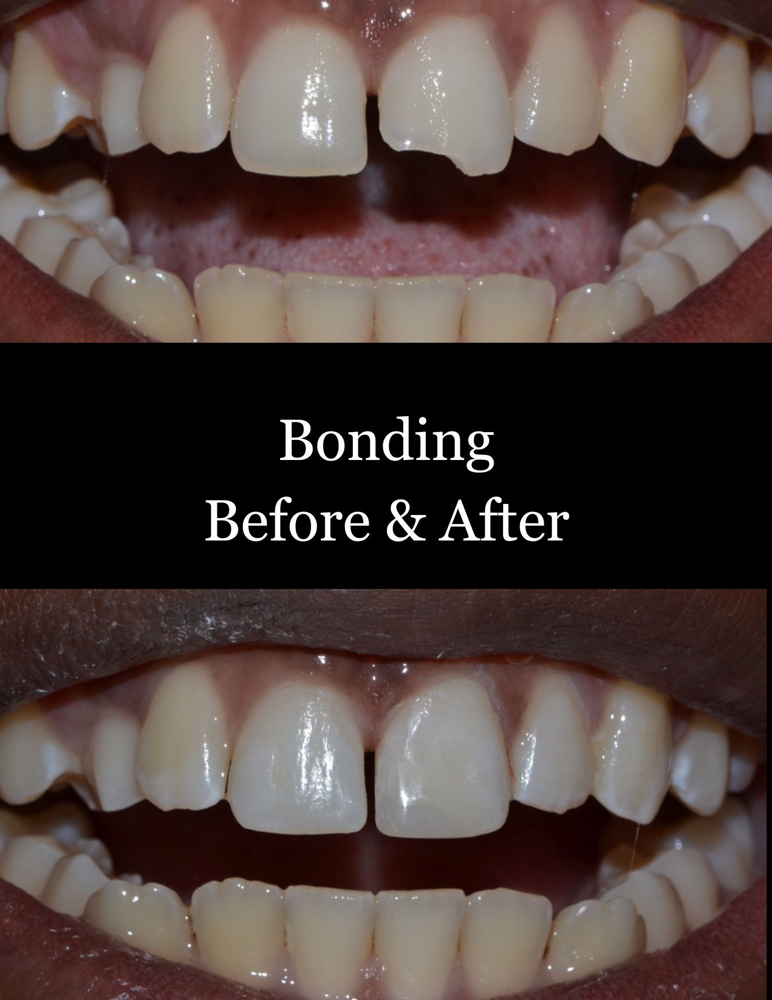 Before-and-after close-up of teeth bonding, showing a gap filled with white dental work.