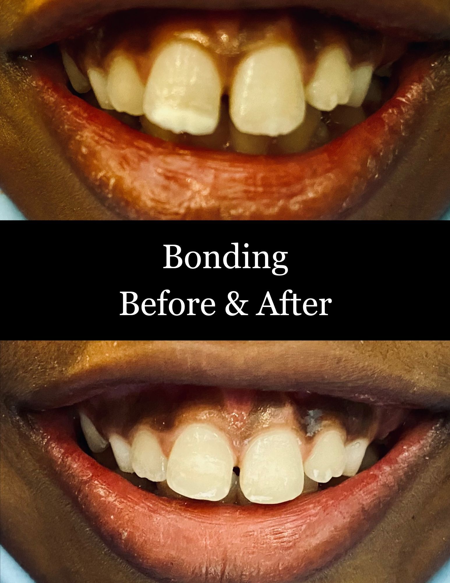 Dental bonding before-and-after close-up of teeth with centered text