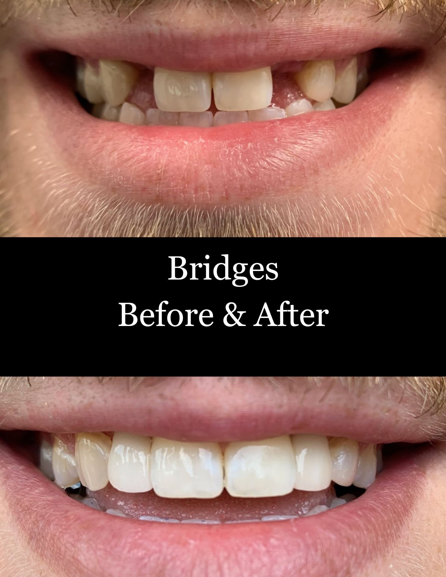Teeth bridge before-and-after comparison showing improved white front teeth and smile