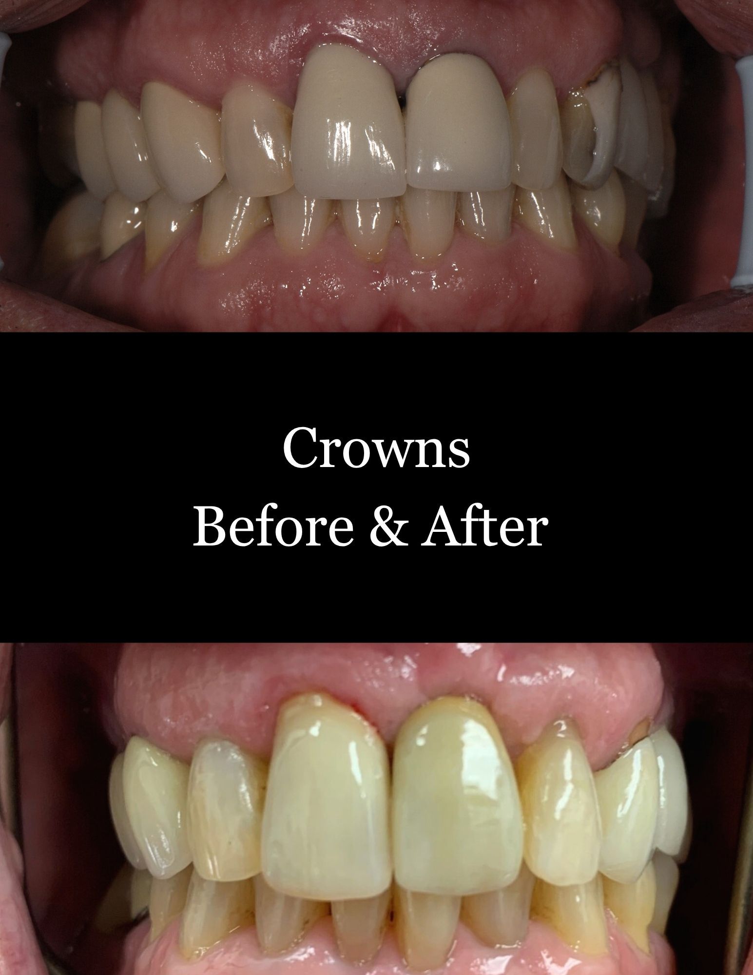 Teeth crowns before and after: uneven, discolored teeth replaced with bright, even crowns.