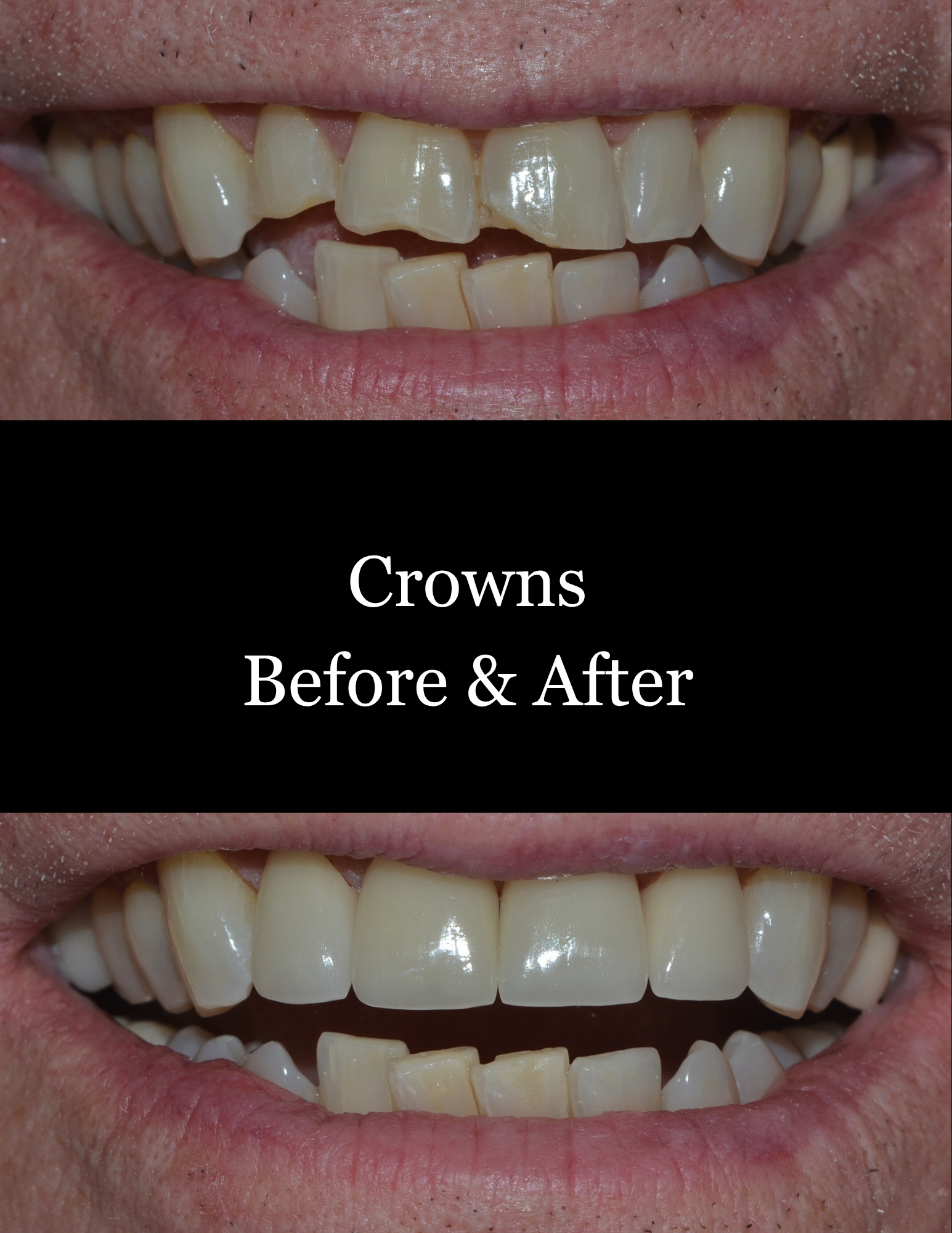 Before-and-after close-up of teeth with crowns