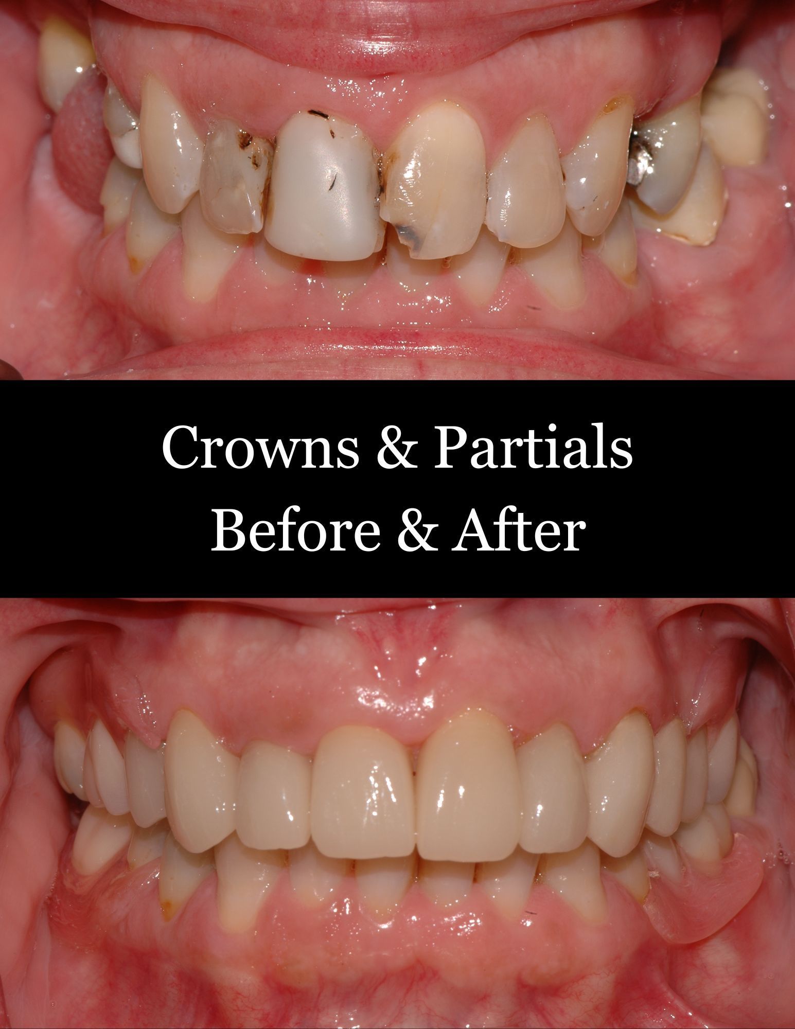 Dental crowns and partials before-and-after photo