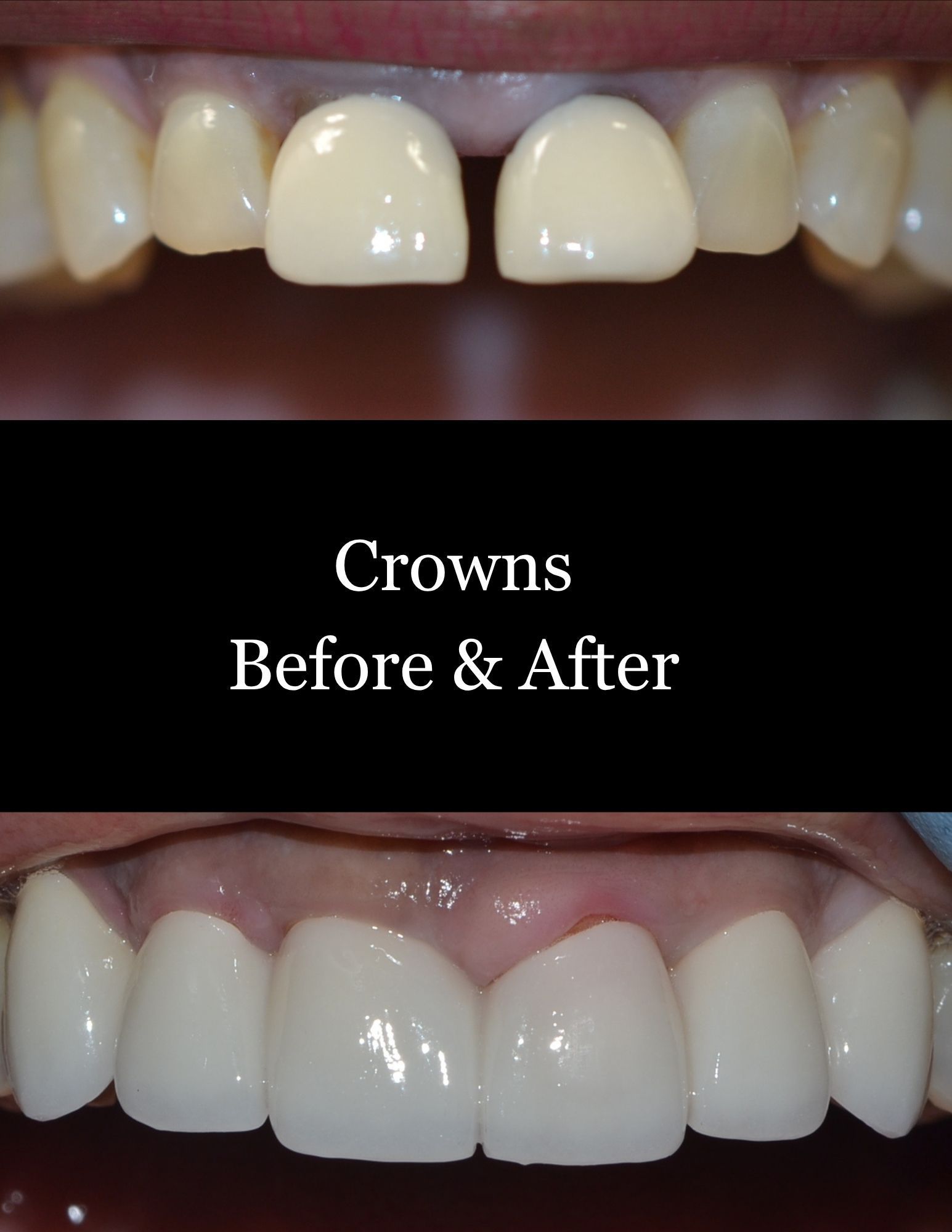 Before-and-after dental crowns showing discolored teeth