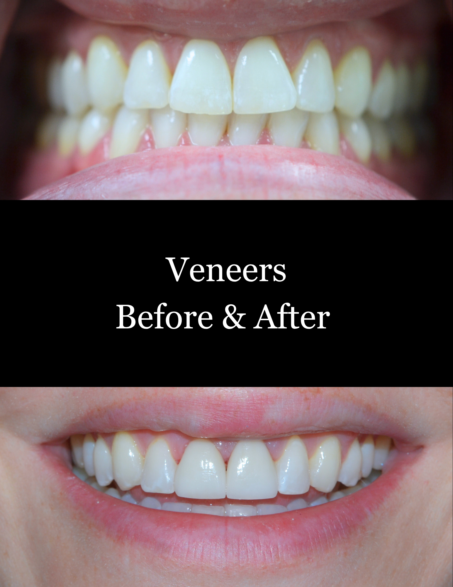 Before-and-after close-up of teeth with veneers, showing improved alignment and brightness.