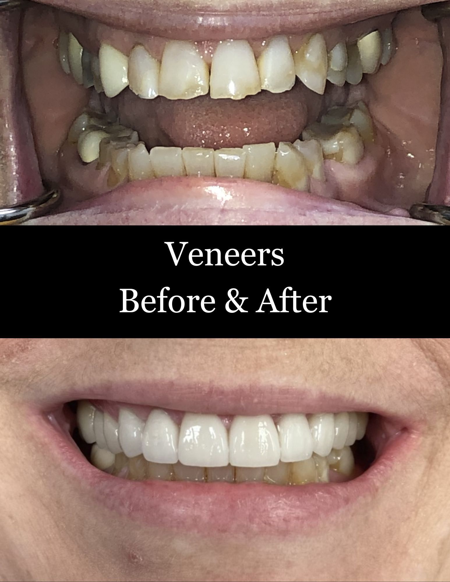 Veneers before-and-after showing damaged teeth transformed into a bright white smile