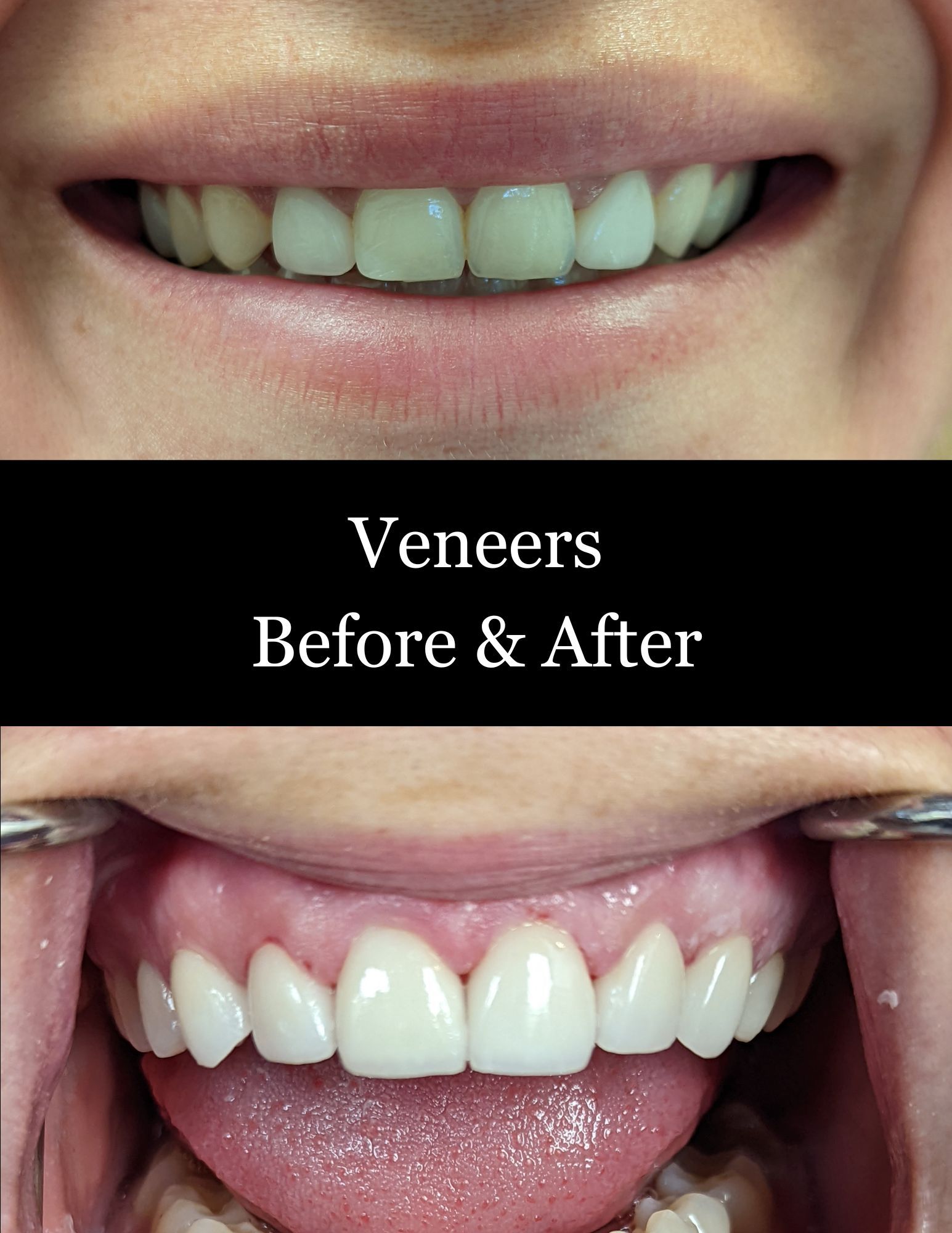 Veneers before and after: top shows uneven teeth, bottom shows bright, even smile with gums visible