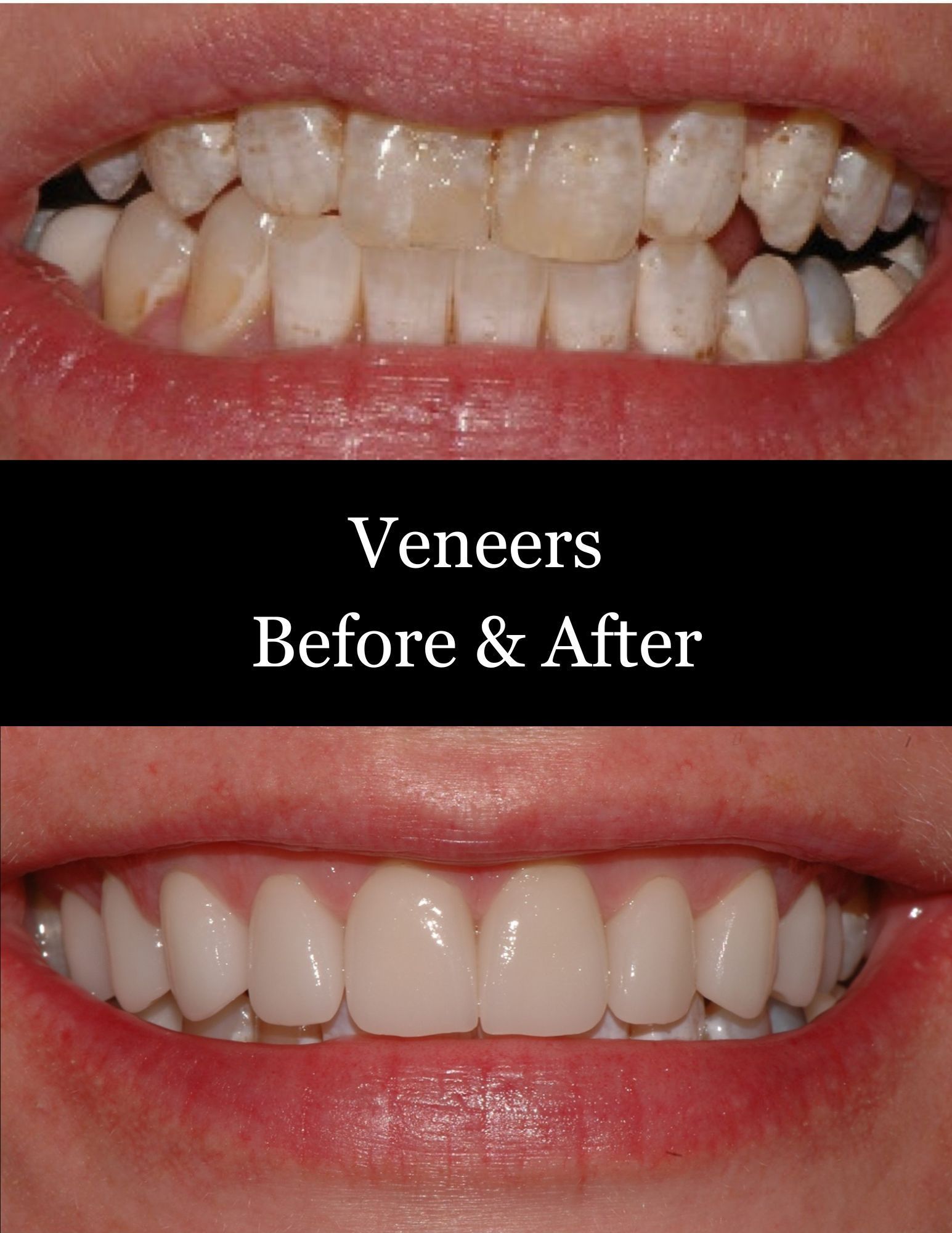 Before-and-after smile showing veneer treatment: crooked teeth on top, straight white teeth on bottom.