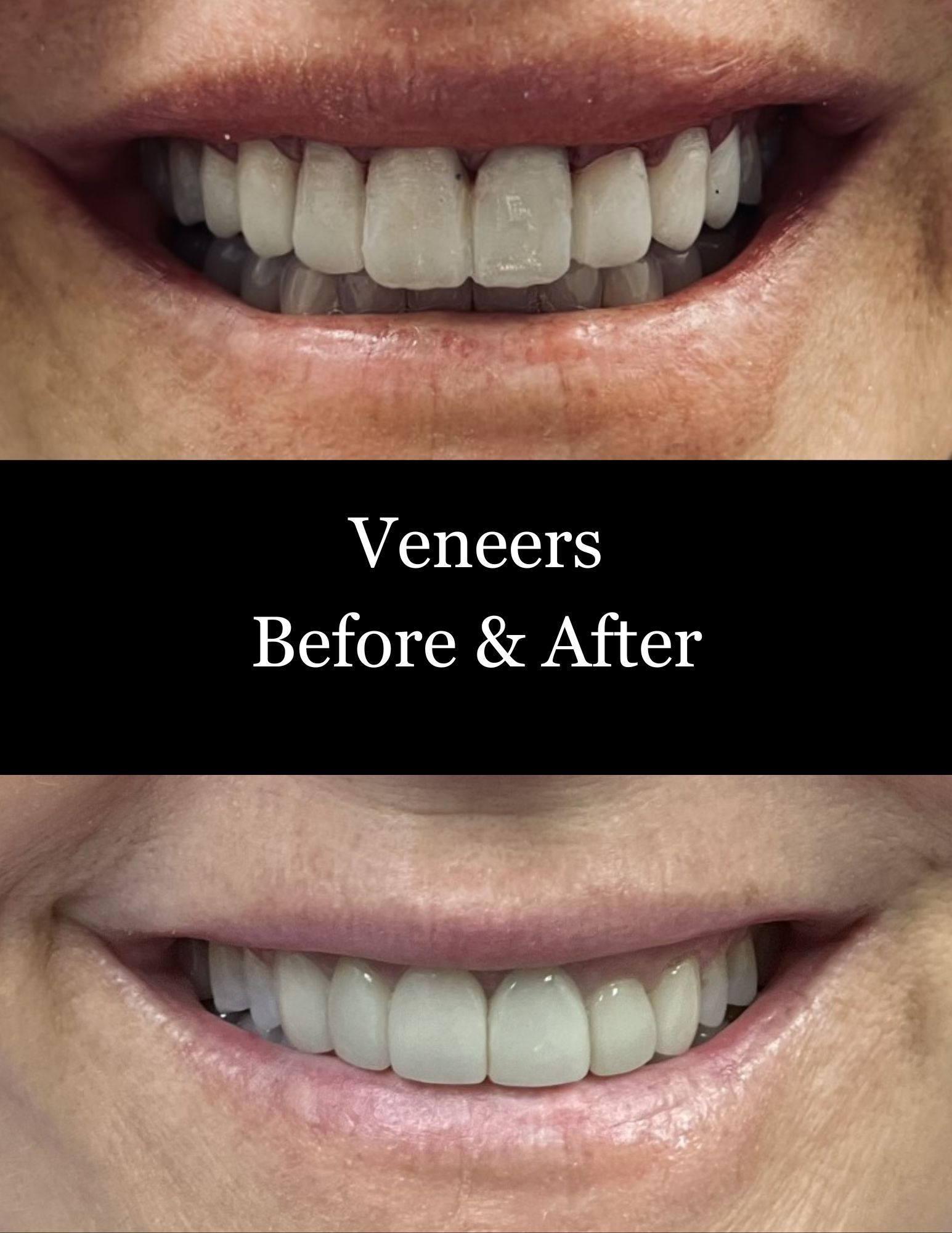 Before-and-after close-up of teeth veneers, with text “Veneers Before & After” between images