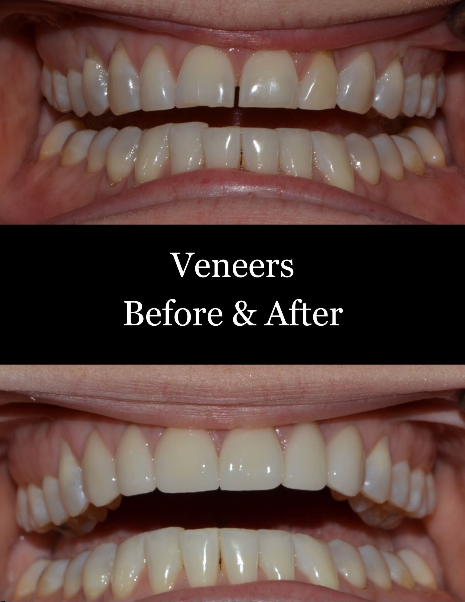 Teeth before and after veneers, showing whiter, more even smile 개선