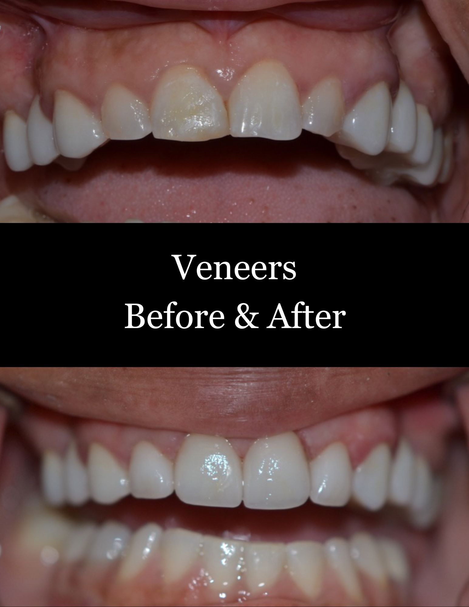 Before-and-after dental veneers showing improved front teeth alignment and brightness.
