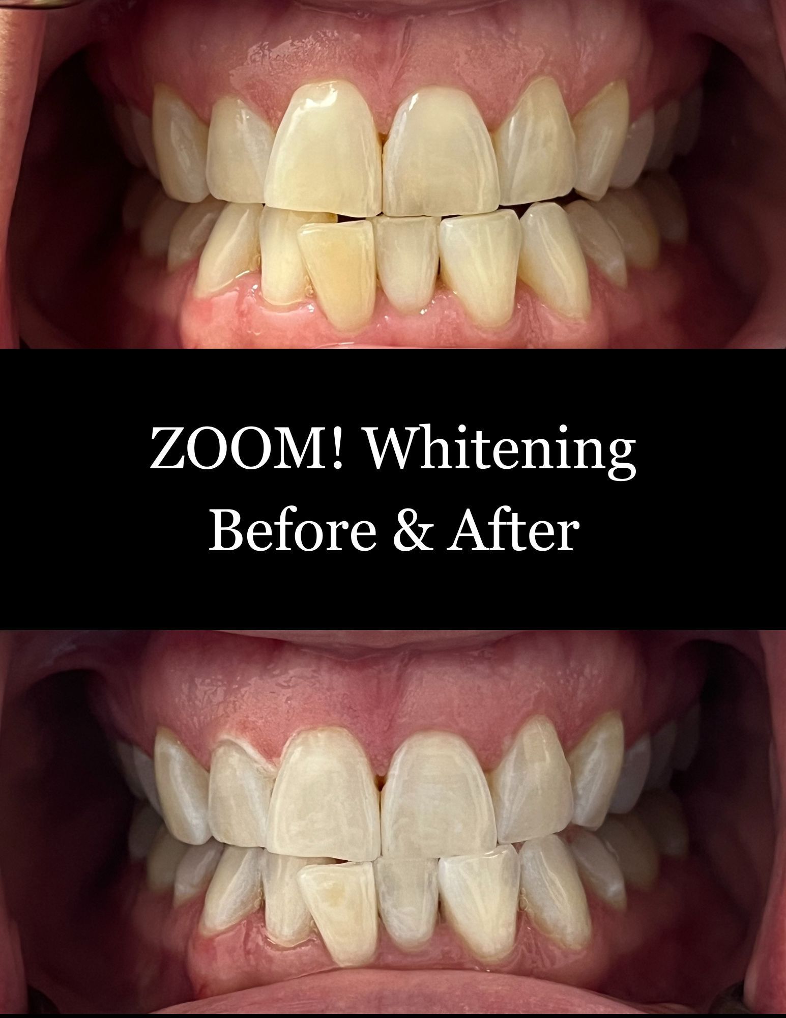 Before-and-after close-up of teeth whitening, with brighter teeth in the lower image.