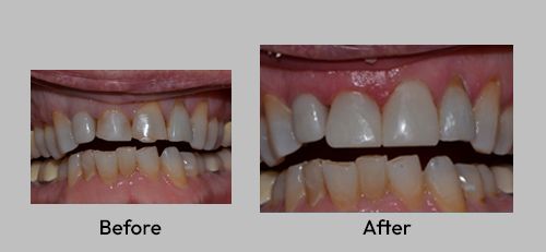 Before-and-after close-up of teeth whitening, showing brighter teeth after treatment