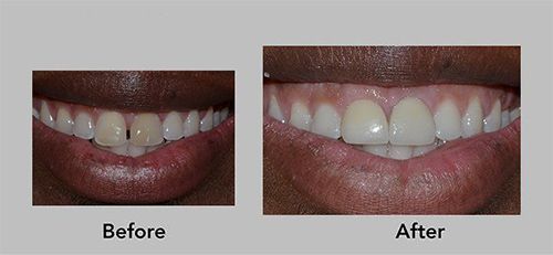Before-and-after close-up of a smiling mouth with brighter white teeth and pink gums.