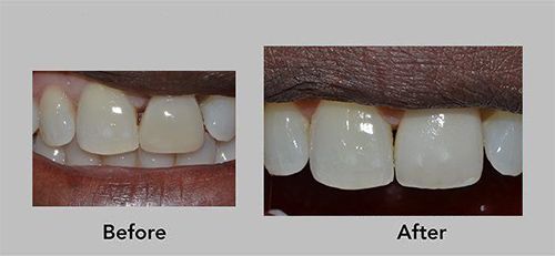 Before-and-after close-up of teeth, showing brighter, more aligned teeth after treatment.