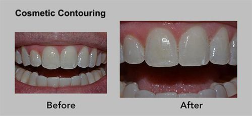Before-and-after of cosmetic contouring on teeth, showing a brighter, more even smile after treatment