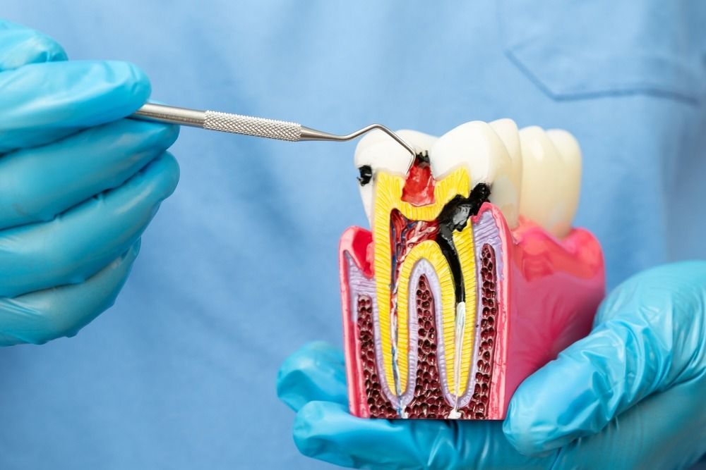 Dental bridge on lower molars between white teeth and pink gums, shown in a close-up mouth illustration