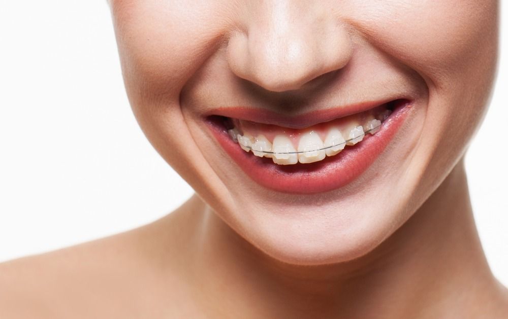Close-up of a smiling mouth with braces against a white background