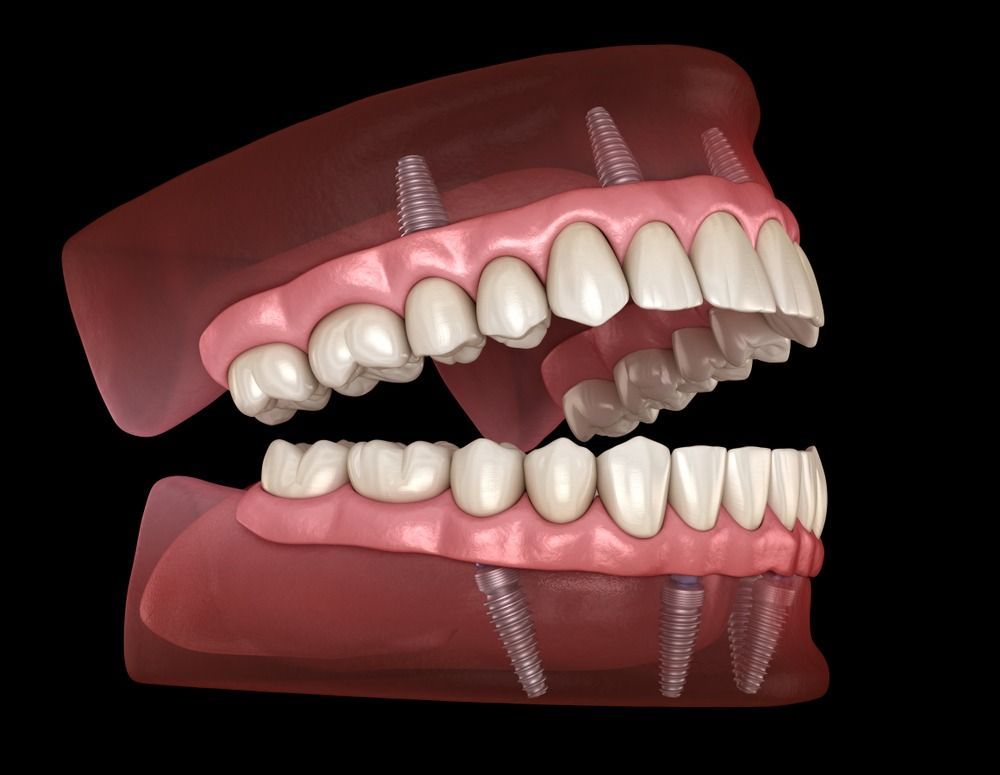 3D render of open upper and lower dentures with pink gums and metal implant posts